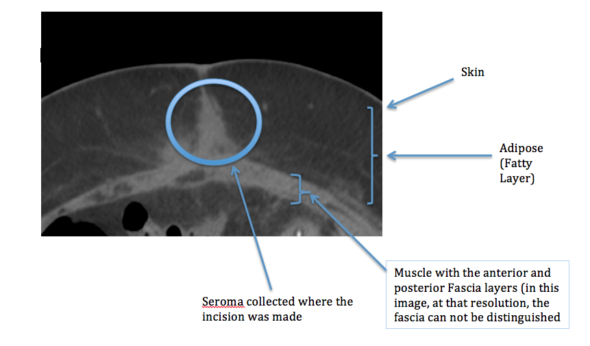 Серома послеоперационного шва фото