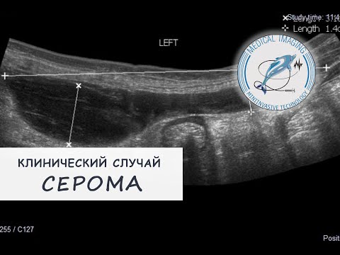 Серома послеоперационного шва фото