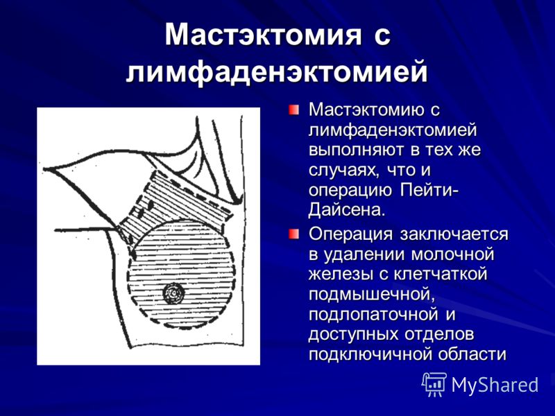 Техника мастэктомии