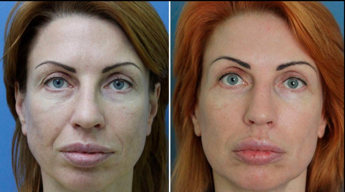 Алмазная шлифовка лица до и после фото