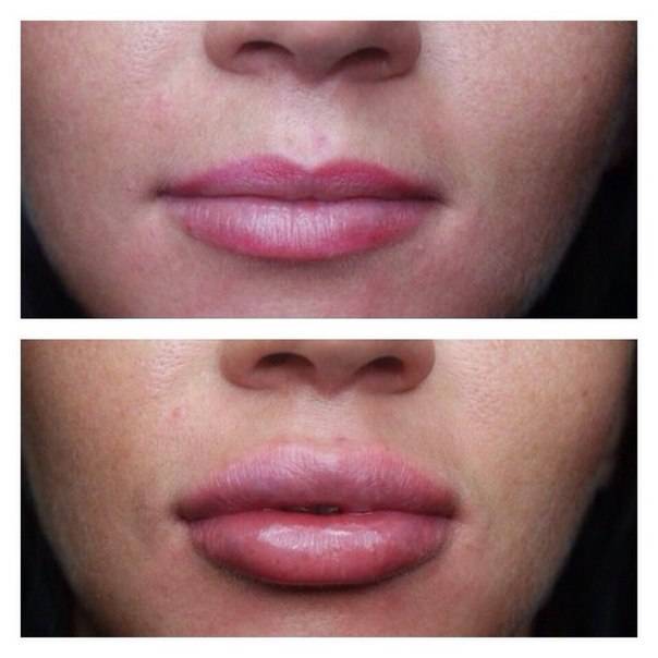 Разворот губ ботоксом фото до и после