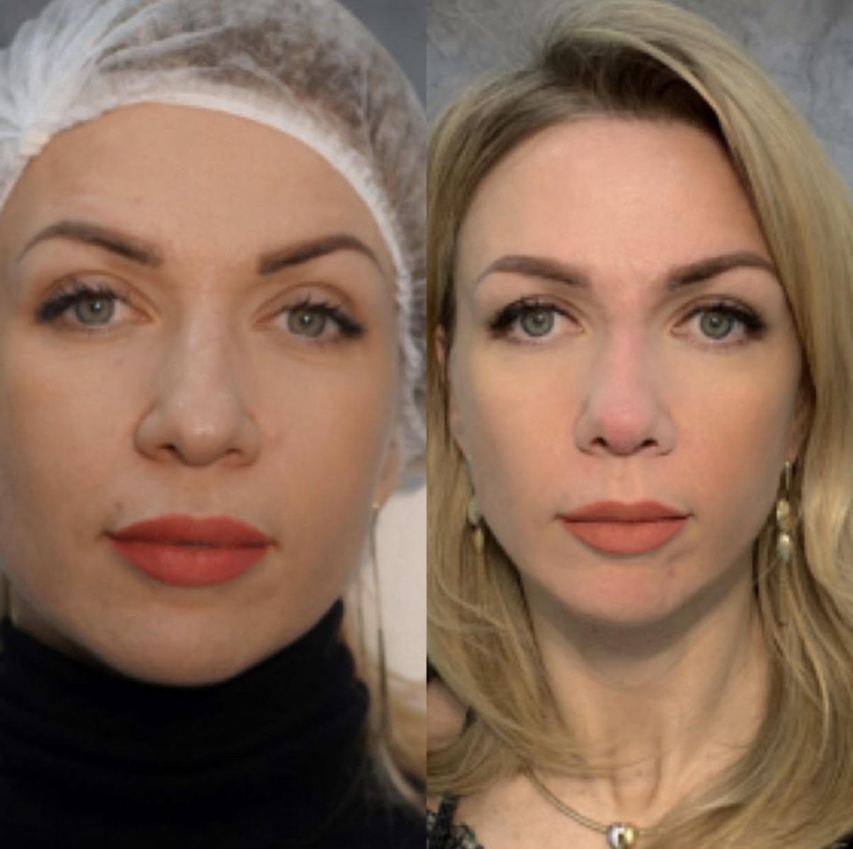 Операция по уменьшению половых губ фото до и после