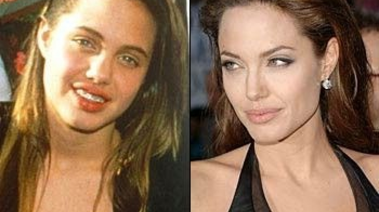 Анджелина джоли рак молочной железы фото до и после