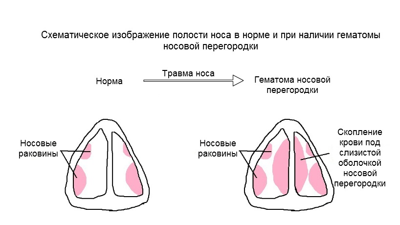 Ушиб носа карта вызова