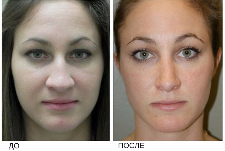 Исправление перегородки носа до и после фото
