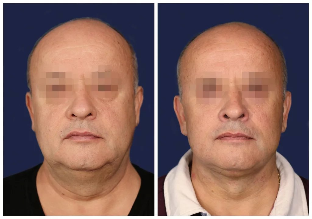 Хирургическая подтяжка нижней трети. Круговая подтяжка лица у мужчин. Подтяжка нижней трети лица у мужчин. Круговая подтяжка лица мужчин до и после.