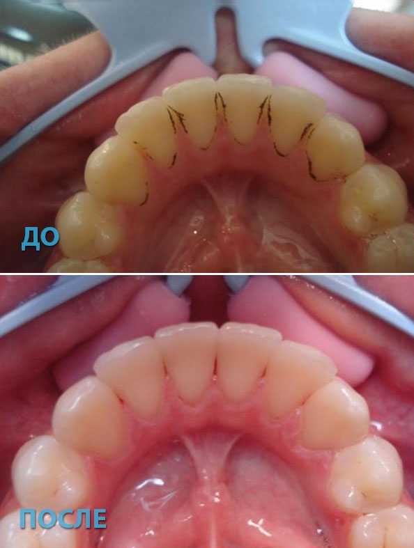 Зубы до и после чистки фото