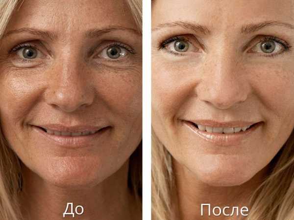 Гиалуроновая кислота для лица уколы эффект до и после фото