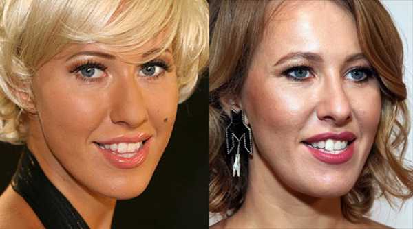 Собчак операция на челюсти фото до и после