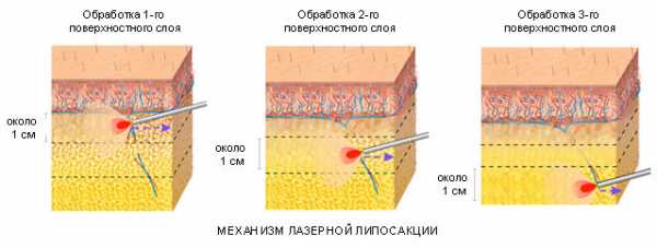 Липосакция подмышек фото до и после