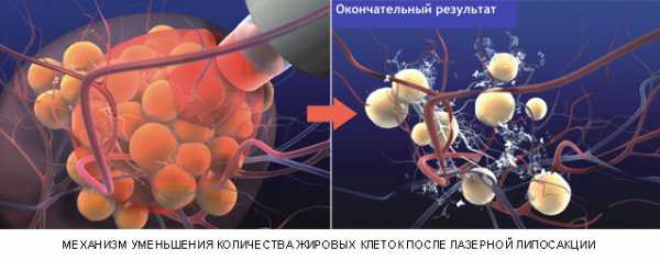 Липосакция живота у мужчин фото