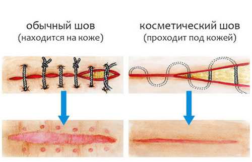 Серома послеоперационного шва фото