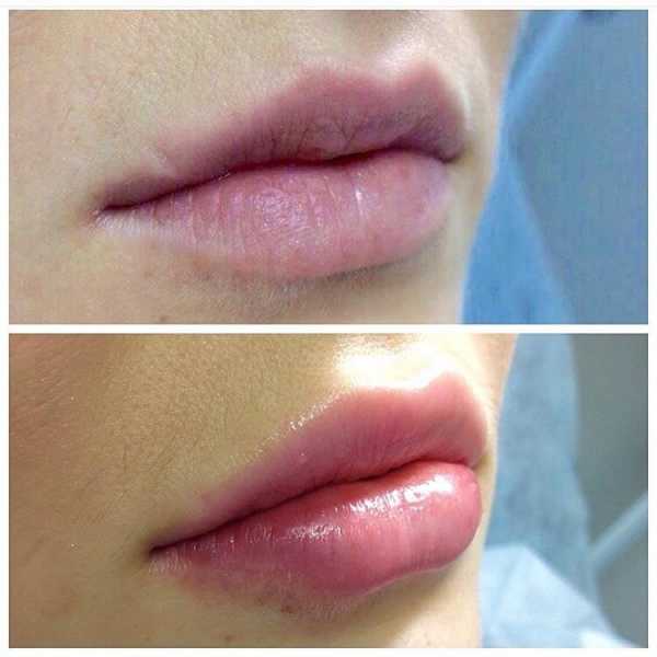 Увлажнение губ гиалуроновой кислотой без увеличения фото до и после