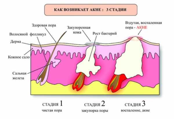 Виды прыщей на половых губах фото